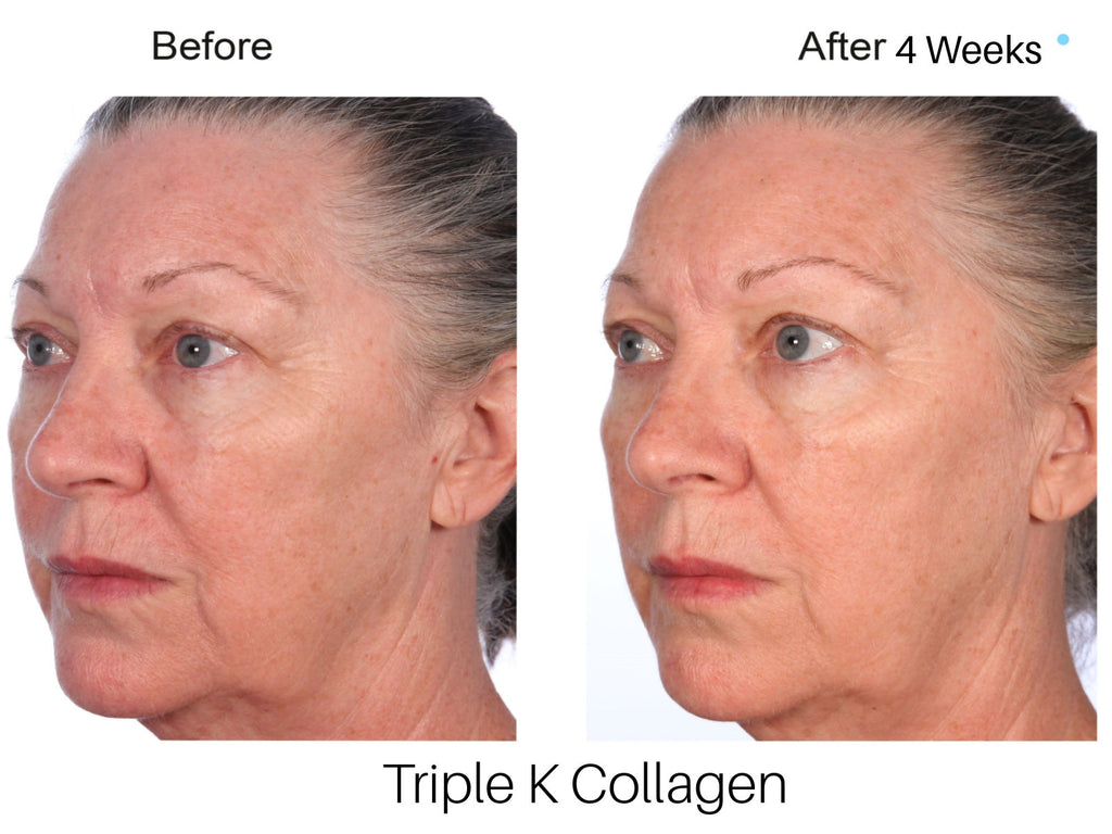 Carol's Natural Face Lift - Collagen for Face Before and After