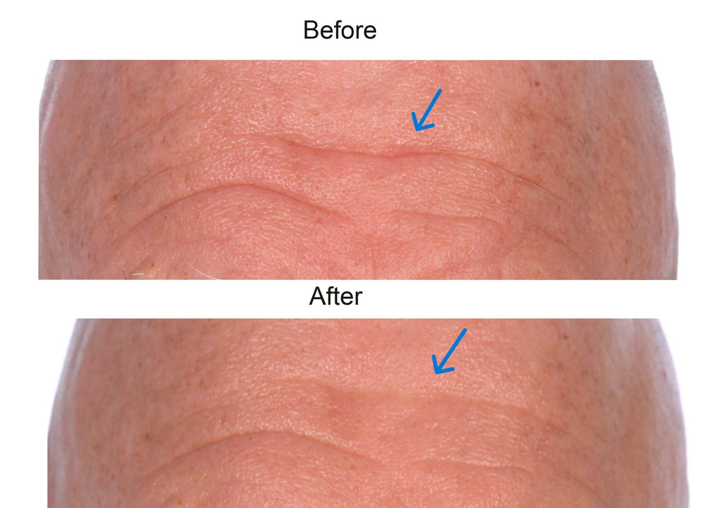 Vincent's Forehead Miracle - Collagen for Wrinkles Before and After