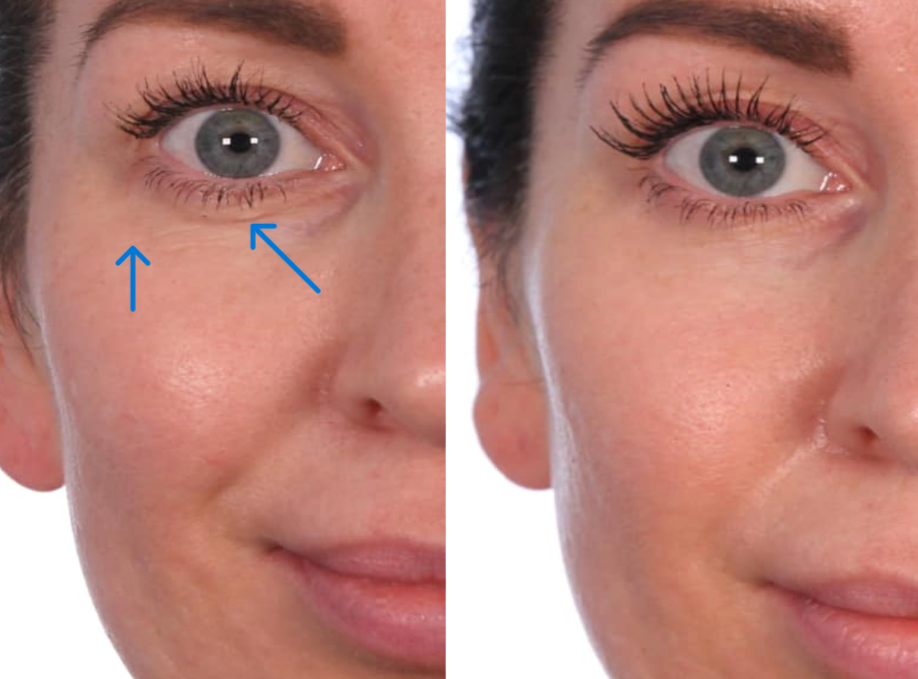 Georgia's Eye Area Miracle - Collagen Eye Treatment Before and After