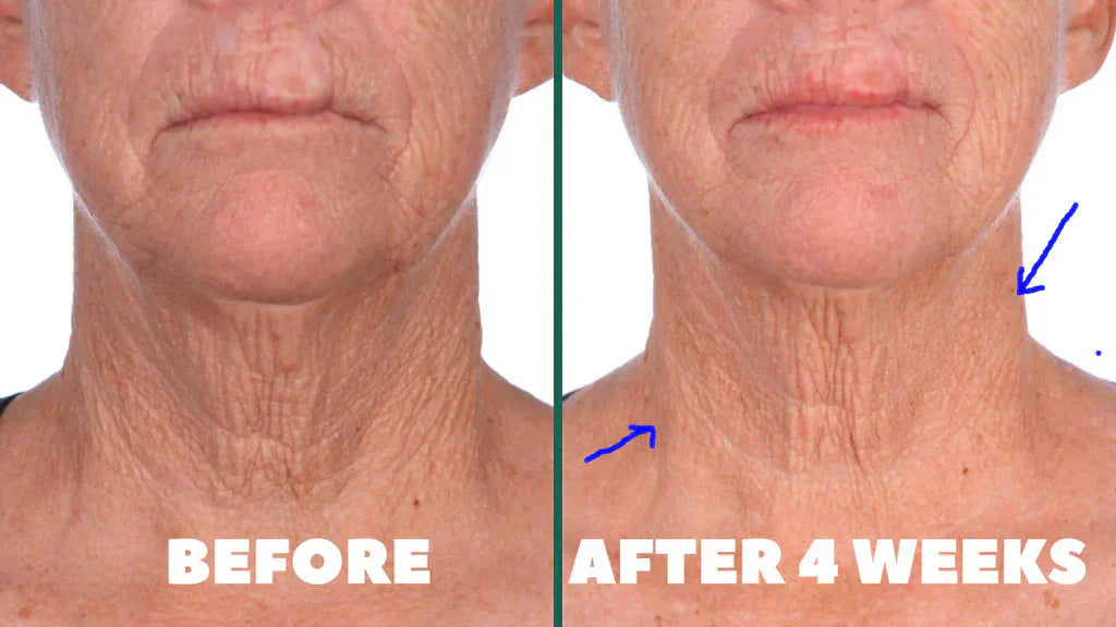 Jodee's Neck Transformation -  Collagen for neck wrinkles before and after