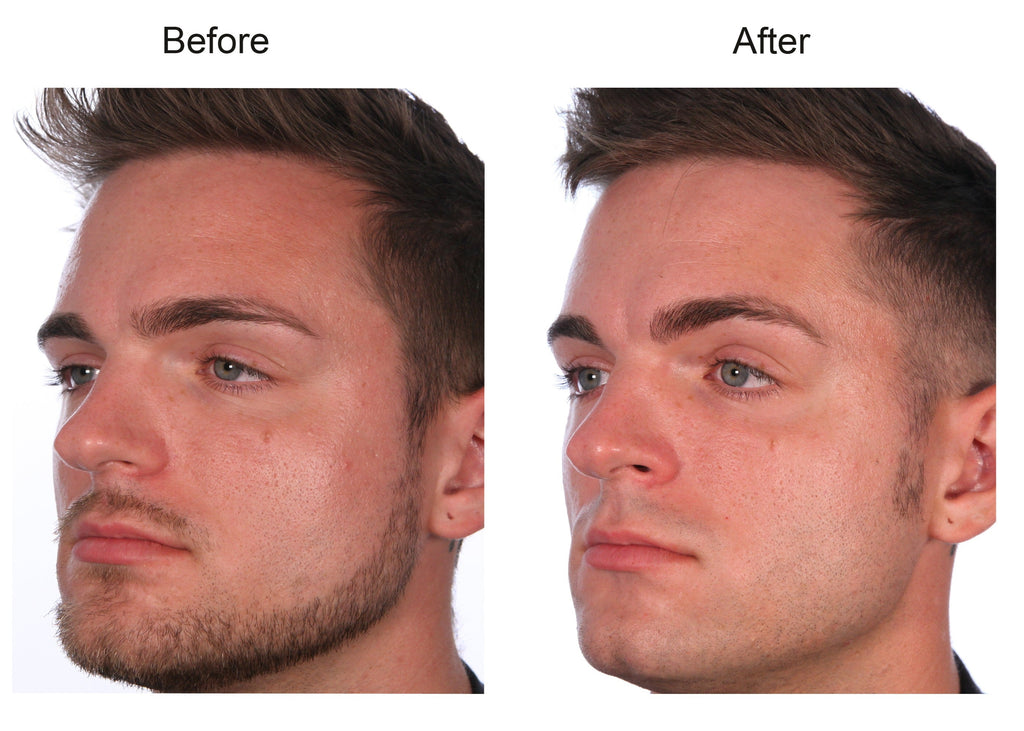 Brandon's Complete Renewal - Collagen for Men Before and After Results