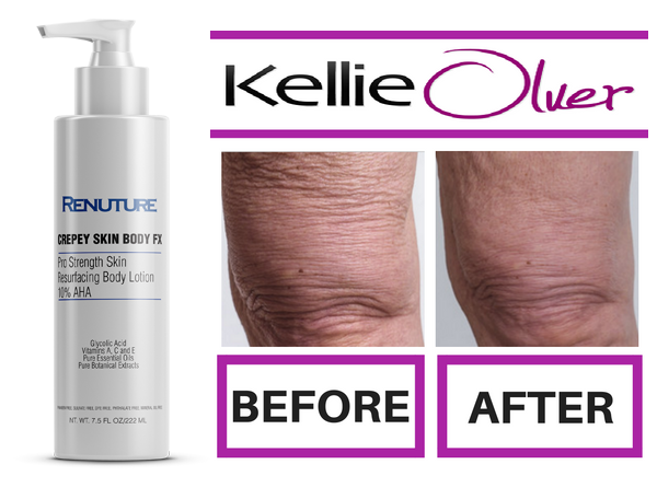 Pictures of crepey skin knee, Before and After