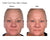 Collagen before and after shows brighter skin, less ruddy complexion, and a fuller collagen face