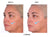 Collagen before and after shows reduced redness, firmer texture, and lifted cheeks with Triple K Collagen.