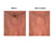 crepey skin pictures, pictures neck wrinkles before and after