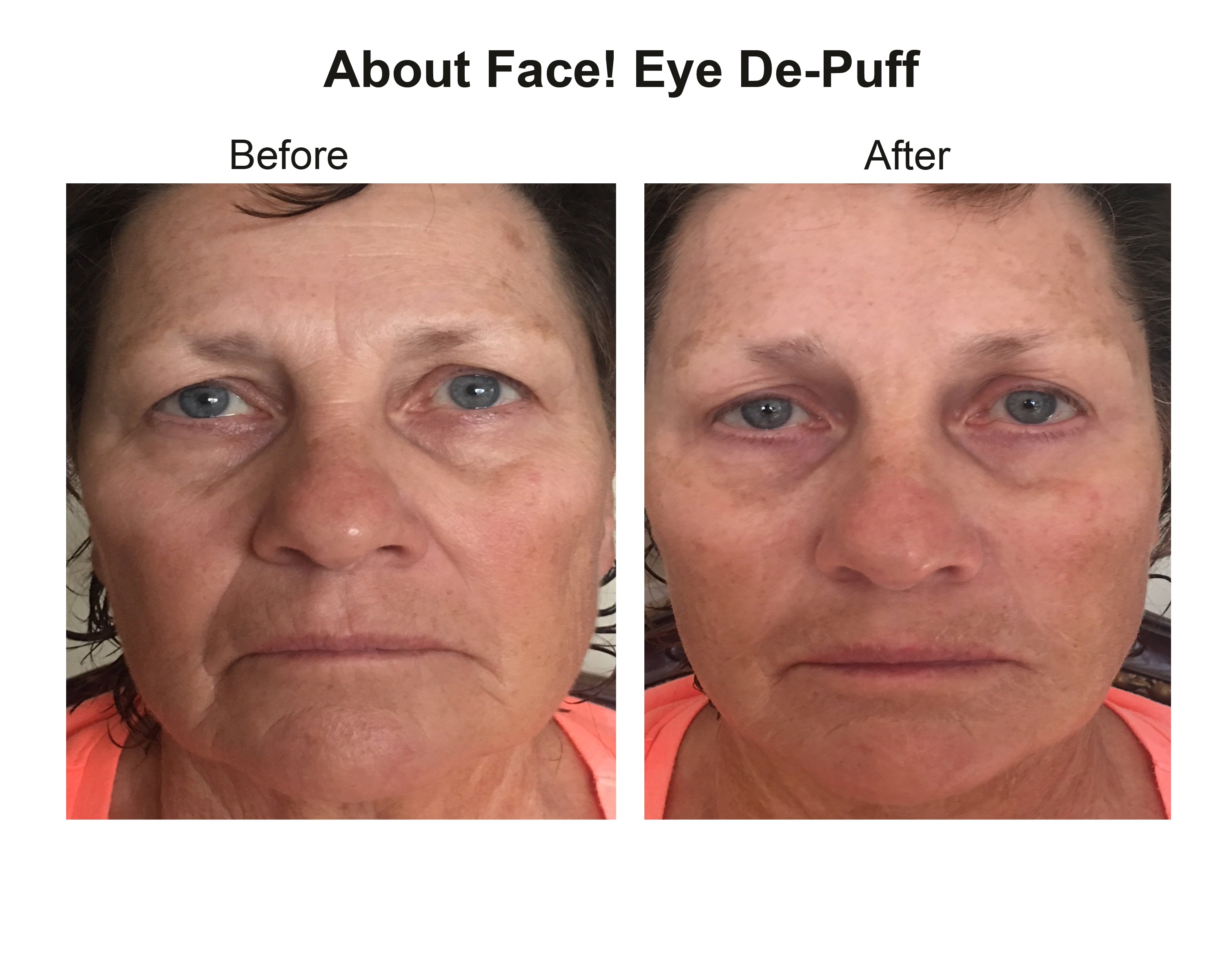 Before and After Results of About Face - Eye De Puff