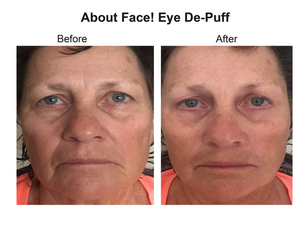 Before and After Results of About Face - Eye De Puff