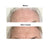Deep forehead wrinkles before and after, forehead lines pictures